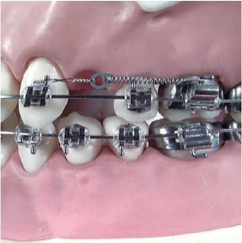 Open coil spring compressing against the arch